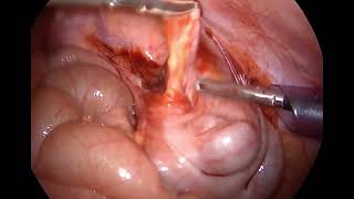 Laparoscopic Appendectomy / Retrocecal appendicitis in 7 year-Old Male patient