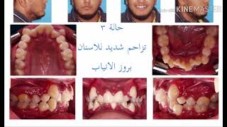 أصعب حالات تجميل الاسنان في عيادة وندرز