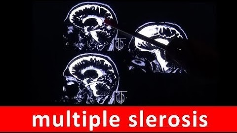 multiple sclerosis MS chronic autoimmune disease in MRI scan by RadiologyTV