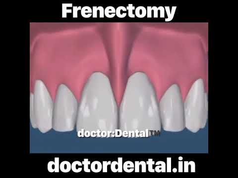 Frenectomy