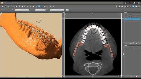 Logiciel D2P (Dicom to Print) segmentation d