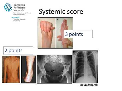 Marfan syndrome