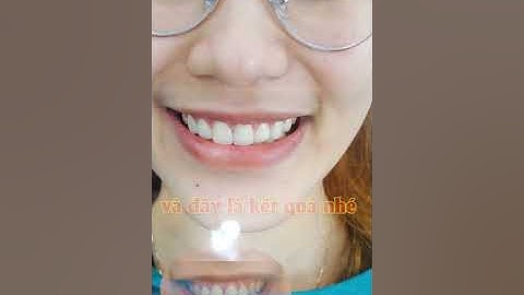Răng sứ thẩm mỹ - khắc phục cười hở nướu răng thưa, khấp khểnh lệch lạc