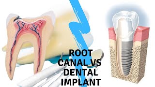 ROOT CANAL VS DENTAL IMPLANT