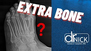 Extra bone in your foot The accessory navicular bone Dr Nick