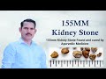 Karan singh vaidh kidney stone rare case studies reports views