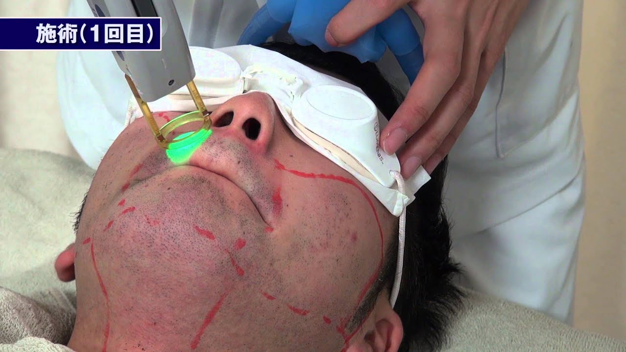 玉澤　ゴリラクリニックヤウチモデル　左投げ Gorilla Clinic Hair Removal] Jun Yoshida 01 | Taking on the