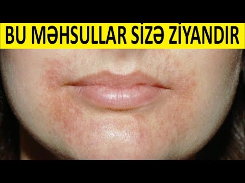 DİQQƏT! Ağız kənarında səpkilər - BU MƏHSULLARDAN UZAQ DURUN