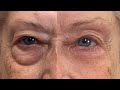 HOW TO GET RID OF EYE BAGS INSTANTLY | FIERCE AGING | Nikol Johnson