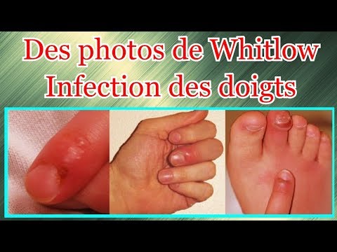 Vidéo: Comment traiter Whitlow : 15 étapes (avec photos)