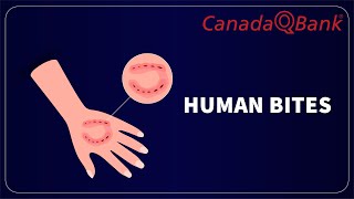 Human Bites: Infection Risk, Treatment & When to Worry | Emergency Medicine | CanadaQBank Profile
