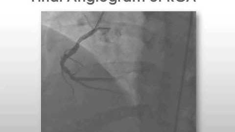 Using Pressure Wire to Test Non-culprit Lesions During ACS