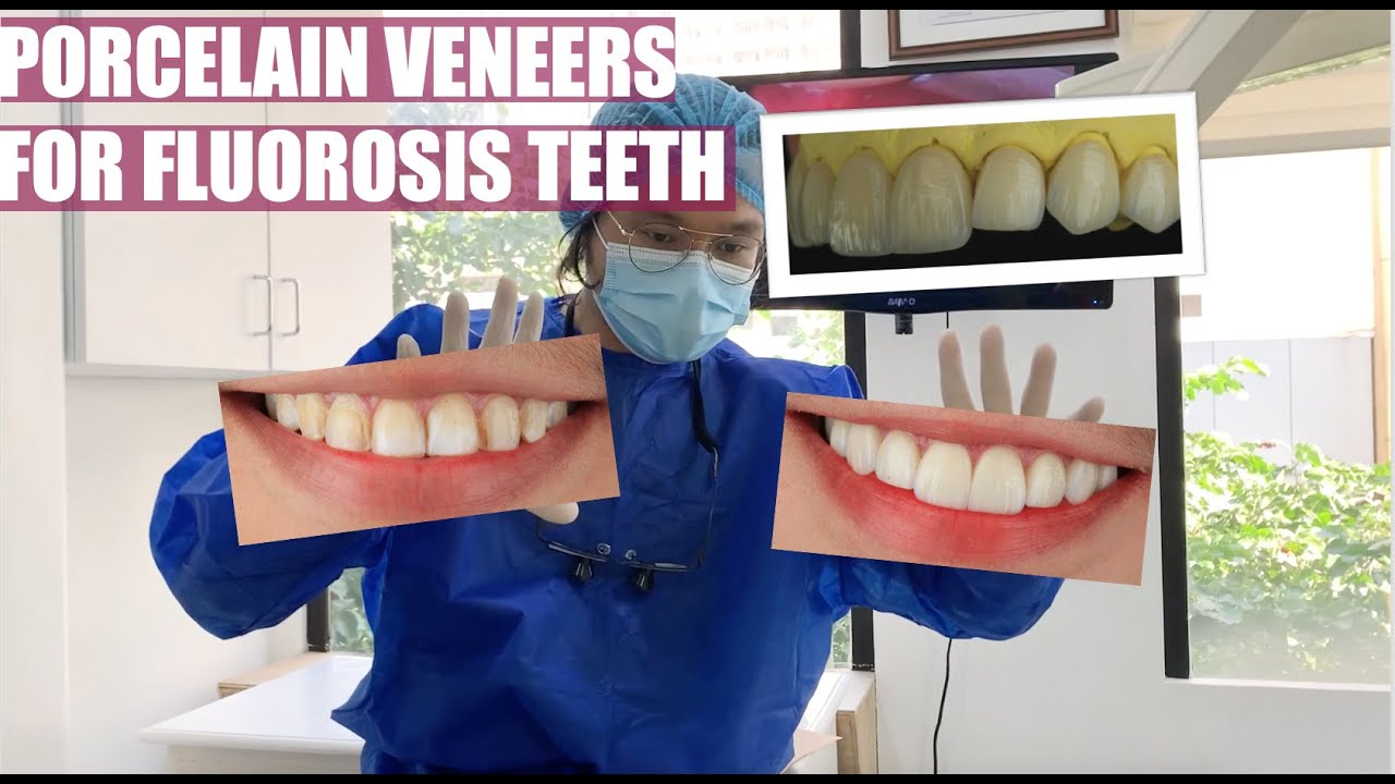 Beautiful Porcelain Veneers for Fluorosis Teeth Apostol Dental