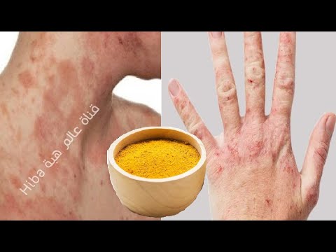 How To Treat Eczema Naturally : Top Home Remedies For Eczema l Skin Healing Journey