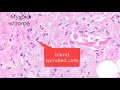 Spindle cell lipoma