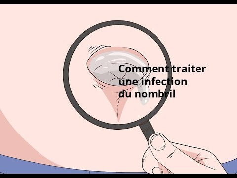 Vidéo: 3 façons de traiter une infection de votre nombril