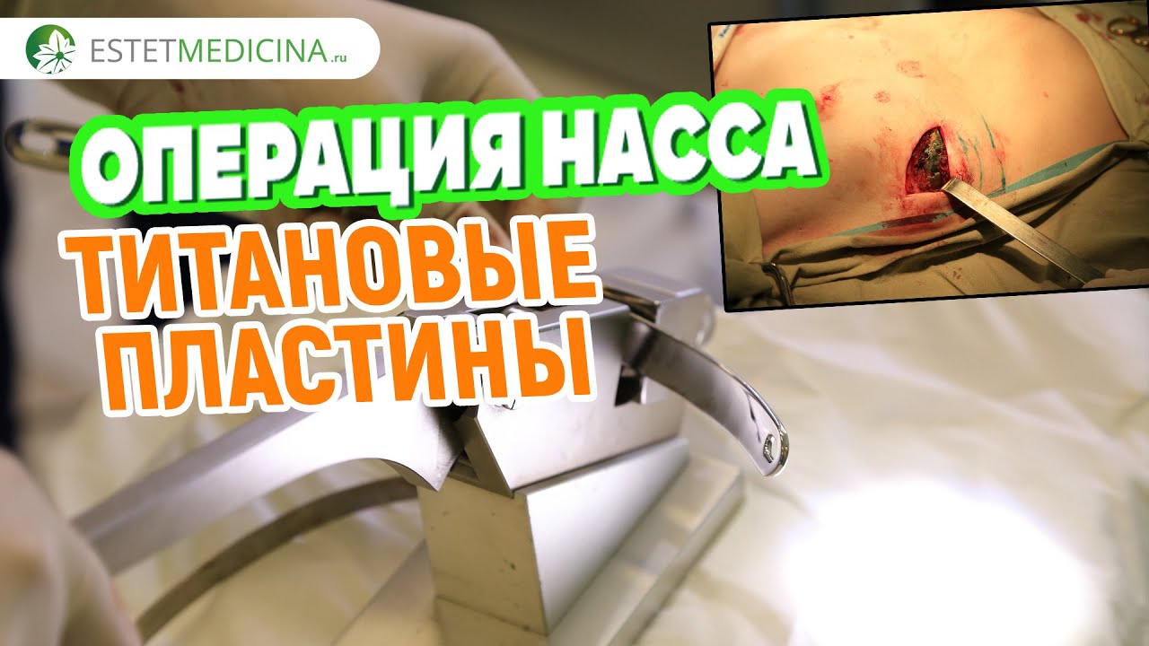 Воронкообразная деформация грудной клетки: причины и лечение | Интернет-журнал Estetmedicina.ru