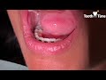 Orthodontic Bracket Repositioning - Bite Plate off - Tooth Time Family Dentistry New Braunfels