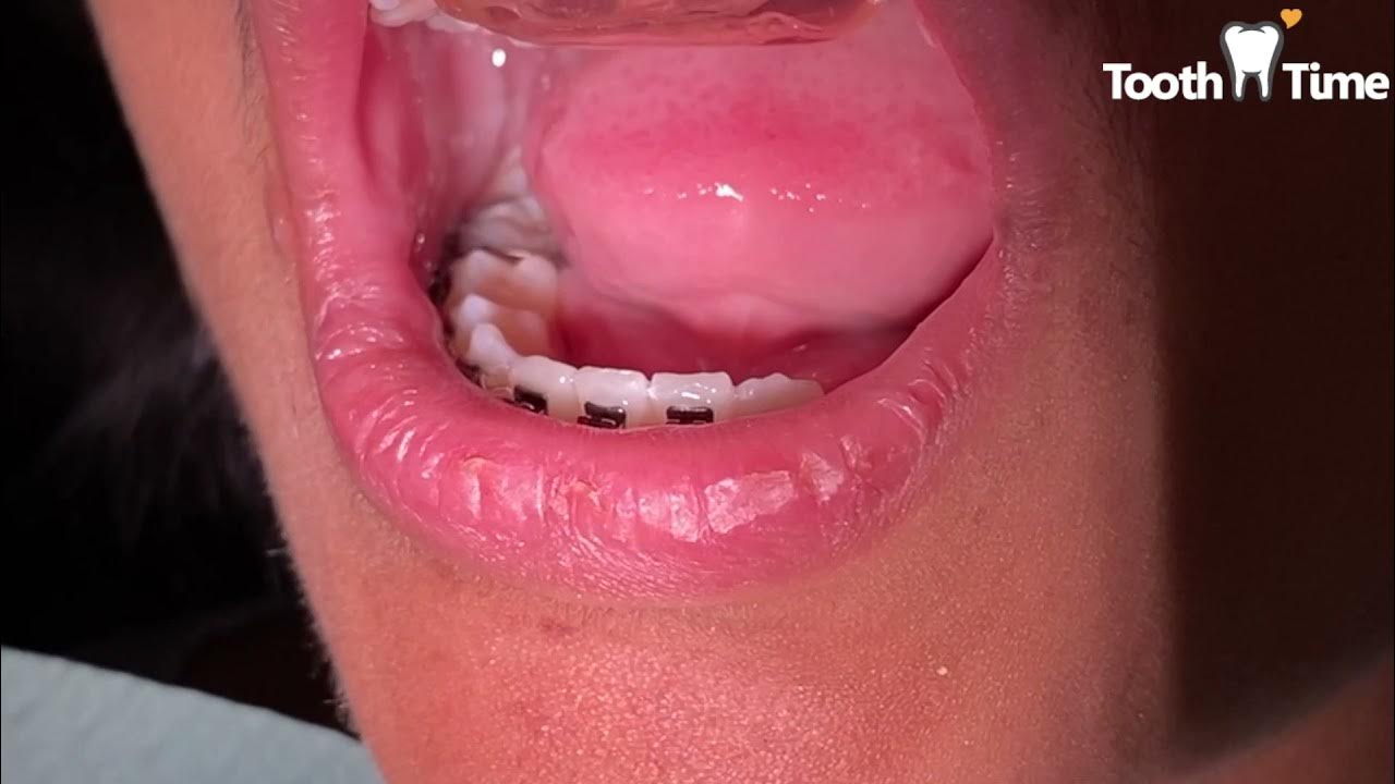 Orthodontic Bracket Repositioning Bite Plate off Tooth Time Family