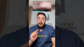 Dishhidrosis or dyshidrotic eczema #dermatology #skincare #dermatologist #dyshidrosis