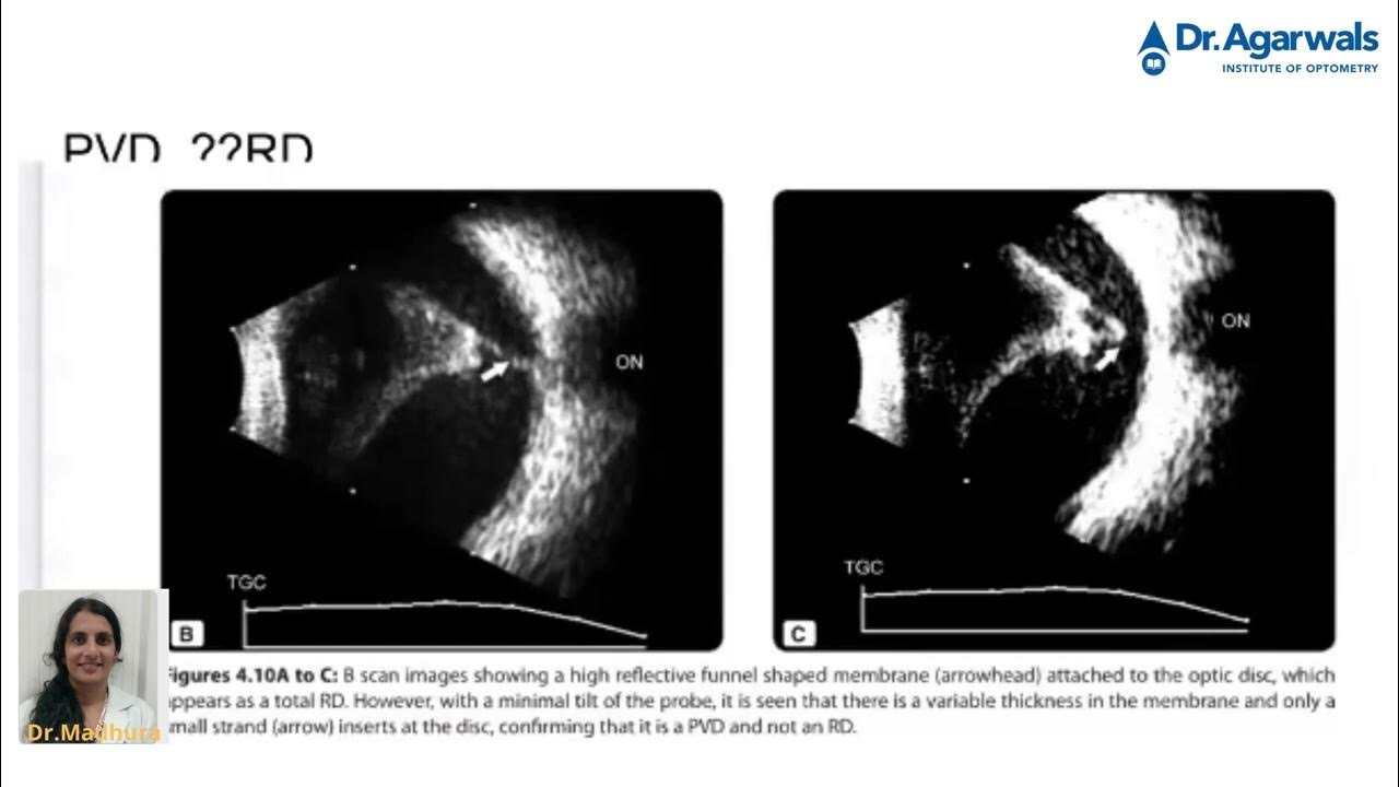 Differentiating pvd and rd in b scan explanation by dr mathura youtube