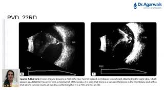 Differentiating PVD and RD in B-Scan - Explanation by Dr. Mathura