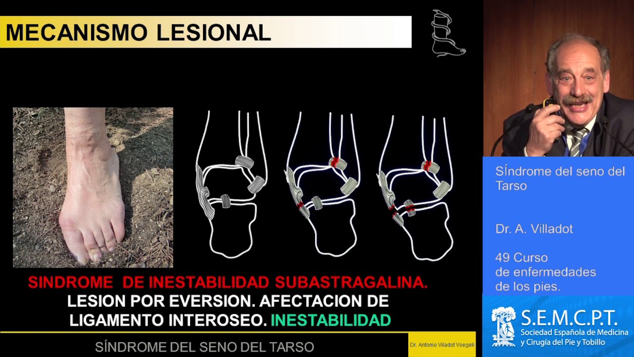 Síndrome seno del tarso YouTube Síndrome seno del tarso YouTube