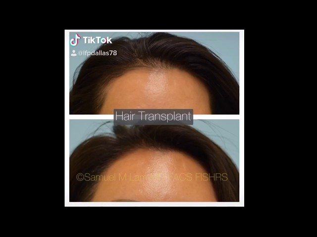 Dallas Female Hair Transplant Before and After