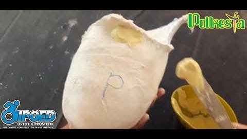 TRANSFEMORAL NEGATIVE CAST RECTIFICATION