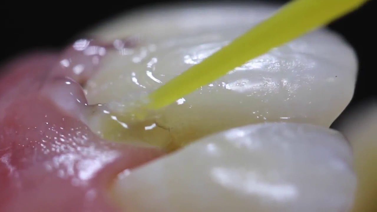 8.1 Control de la hipersensibilidad dentinaria