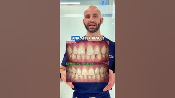 Invisalign Before and After: Closing Spaces and Fixing Bite in only 12 months.
