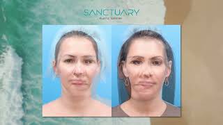 MyEllevate | Sanctuary Plastic Surgery