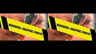 Diddy Trial: Shocking Allegations and Injury Photos of Bryana Bongolan