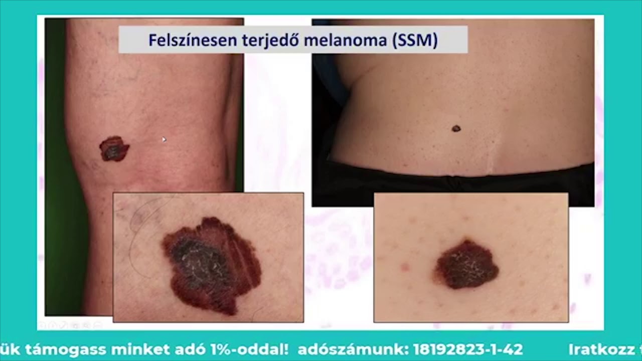 Parazita gyógyszeres kezelés a melanomát kezeli