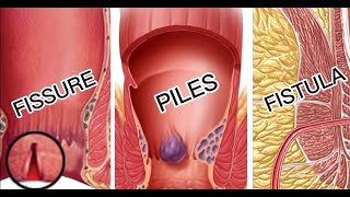 Piles / Fisure / Fistula - Difference explained | Piles vs Fissure vs Fistula - Difference Kiya Hai?
