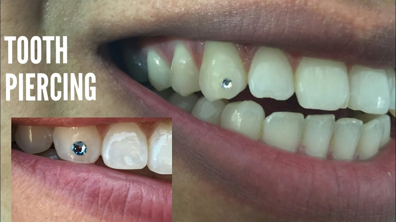 Gemas dentales: ¿Es seguro sumarse a esta tendencia?