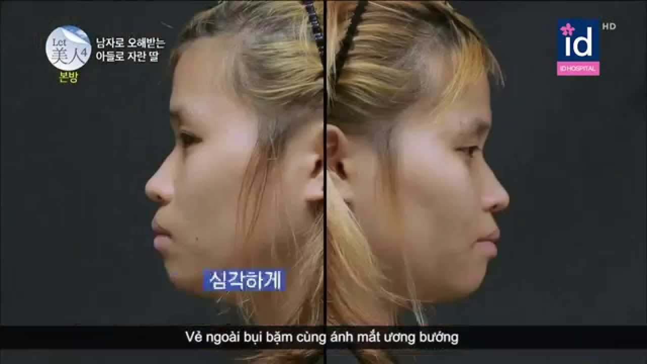 Let Me In Vietsub Phẫu Thuật Thẩm Mỹ Han Quốc Phần 2 Youtube