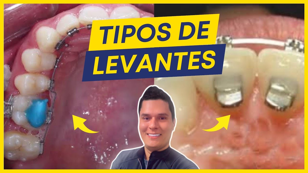 TIPOS DE LEVANTES DE MORDIDA EM ORTODONTIA (QUANDO USAR?)