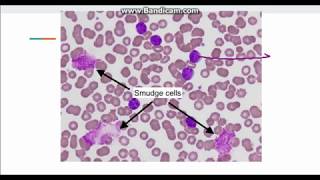 Chronic Lymphocytic Leukemia( CLL)