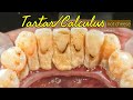 Tartar not cheese | Scaling | Dentist | @Dokter Gigi Ruliyanto