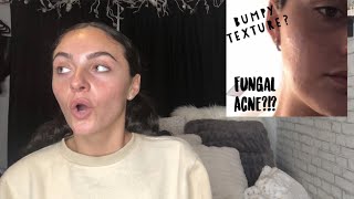 skin care update / acne skin routine