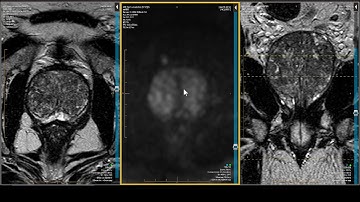 Prostate MRI — PI-RADS 2