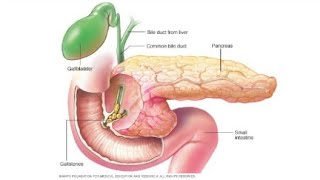 Pancreatitis with mnemonics by Dr Gireesh Kumar KP