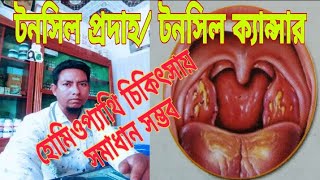 টনসল পরদহটনসল কযনসর হমওপযথত সমধন সমভবDisease Of Tonsilitesহমও ঔষধ দর সসথত