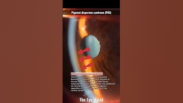 Pigment dispersion syndrome (PDS) #ophthalmology #the_eye_world #youtubeshorts #glaucoma #eyes