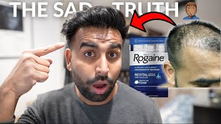 Does Rogaine Work? | My Biggest Regret 6 Years Later... 🤦‍♂️