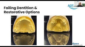 Restoring Complex Full-Arch Cases with a Digital Workflow