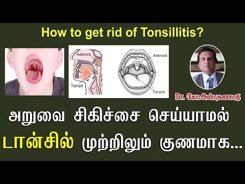 அறுவை சிகிச்சை செய்யாமல் டான்சில் முற்றிலும் குணமாக | Tonsillitis and Adenoids natural cure