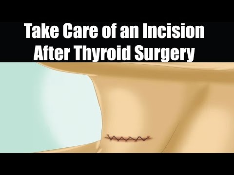Como cuidar de uma incisão Após a cirurgia da tireóide