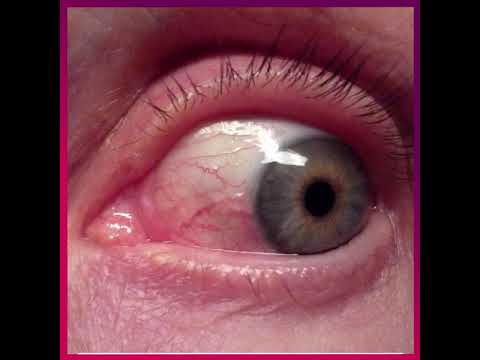 Less Common Symptoms of COVID-19 #Shorts